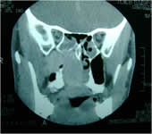 Cirugia de cráneo