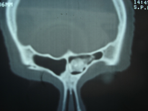 Cirugia de cráneo